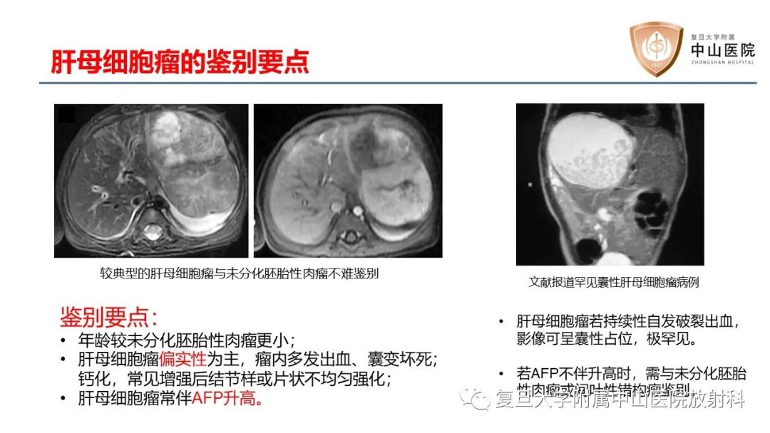 影像PPT - 【病例】肝脏未分化胚胎性肉瘤2例MR影像-25