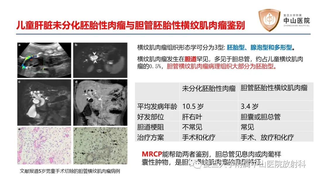 影像PPT - 【病例】肝脏未分化胚胎性肉瘤2例MR影像-26