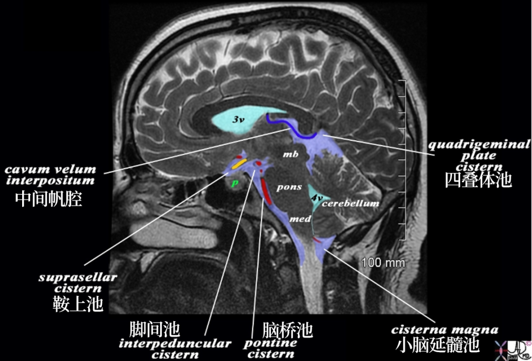 影像PPT - 颅内这些位置容易忽视,这 36 个病例差一点就漏诊了-3 影像PPT - 颅内这些位置容易忽视,这 36 个病例差一点就漏诊了-3