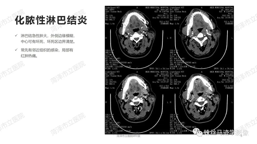 影像PPT - 【PPT】颈部间隙CT和MRI诊断-8