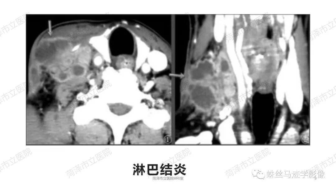 影像PPT - 【PPT】颈部间隙CT和MRI诊断-9
