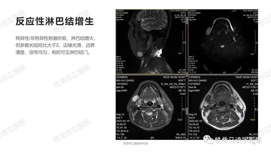影像PPT - 【PPT】颈部间隙CT和MRI诊断-10