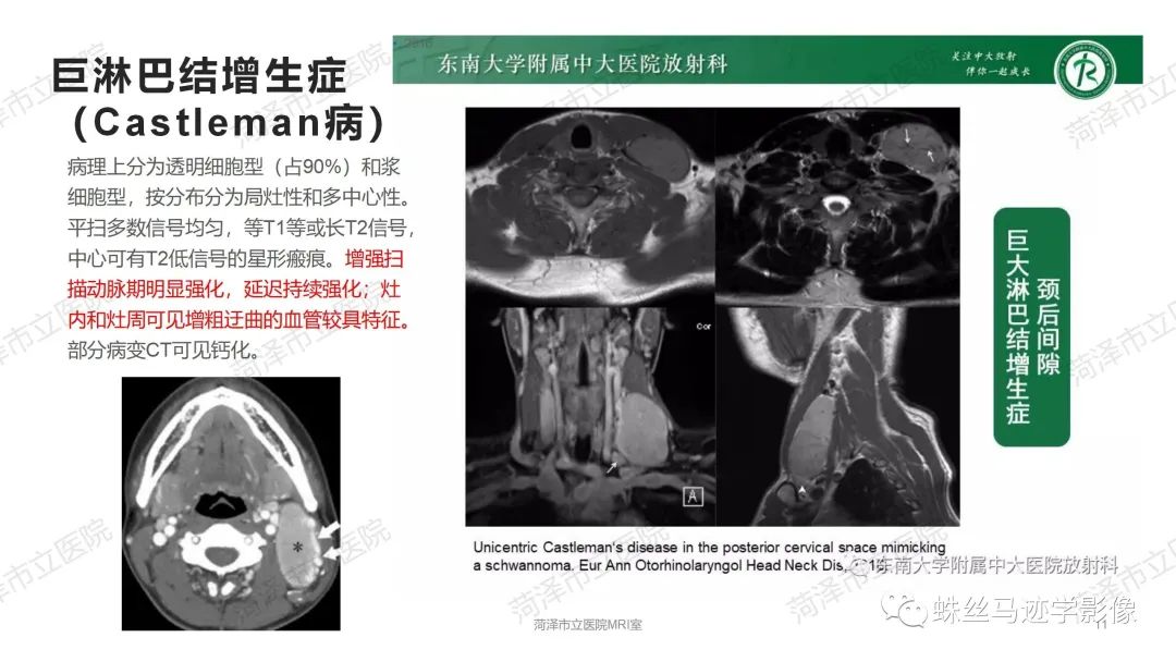 影像PPT - 【PPT】颈部间隙CT和MRI诊断-11