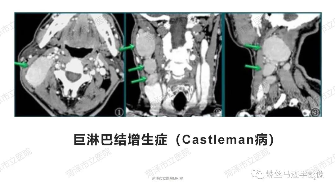 影像PPT - 【PPT】颈部间隙CT和MRI诊断-12