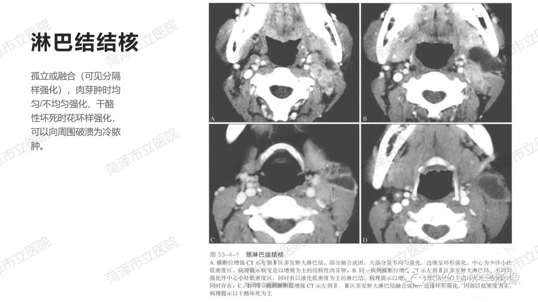 影像PPT - 【PPT】颈部间隙CT和MRI诊断-13