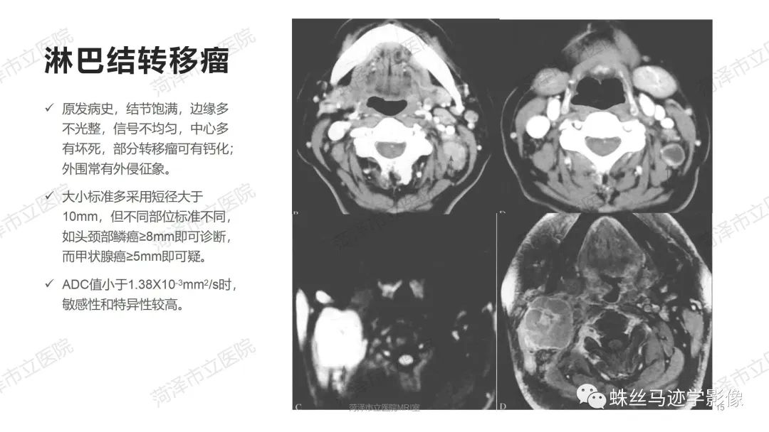 影像PPT - 【PPT】颈部间隙CT和MRI诊断-15