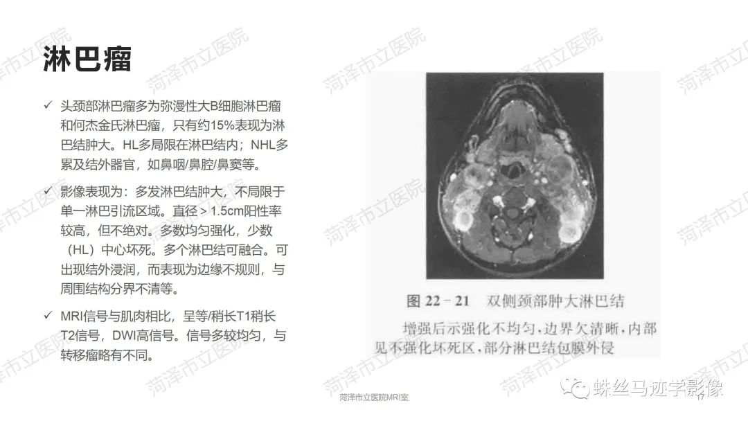 影像PPT - 【PPT】颈部间隙CT和MRI诊断-17