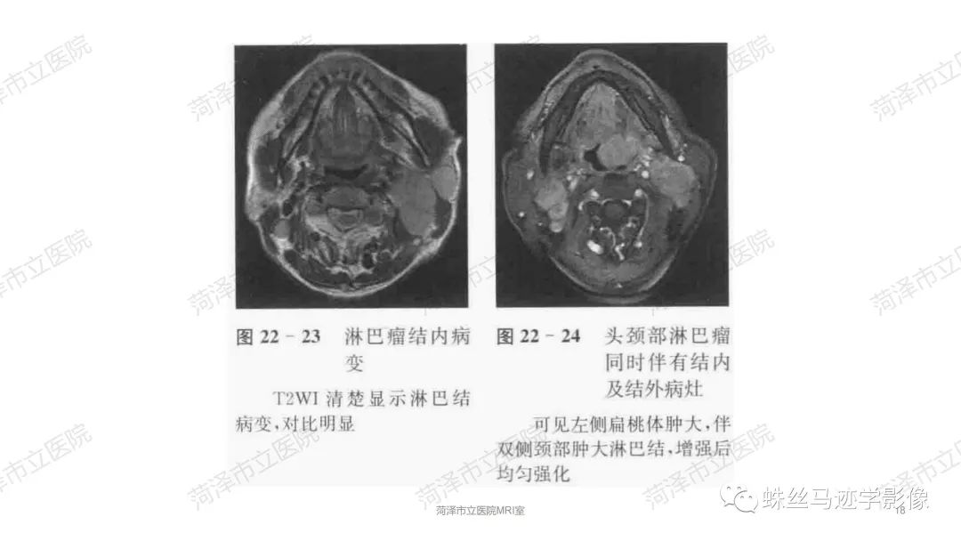 影像PPT - 【PPT】颈部间隙CT和MRI诊断-18