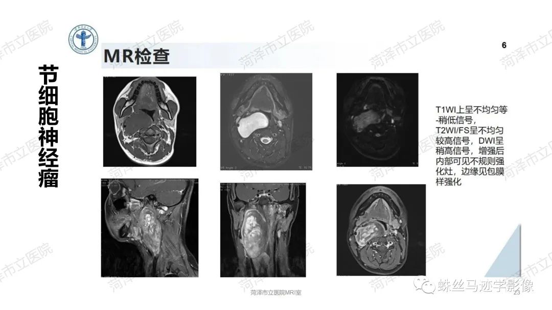影像PPT - 【PPT】颈部间隙CT和MRI诊断-23