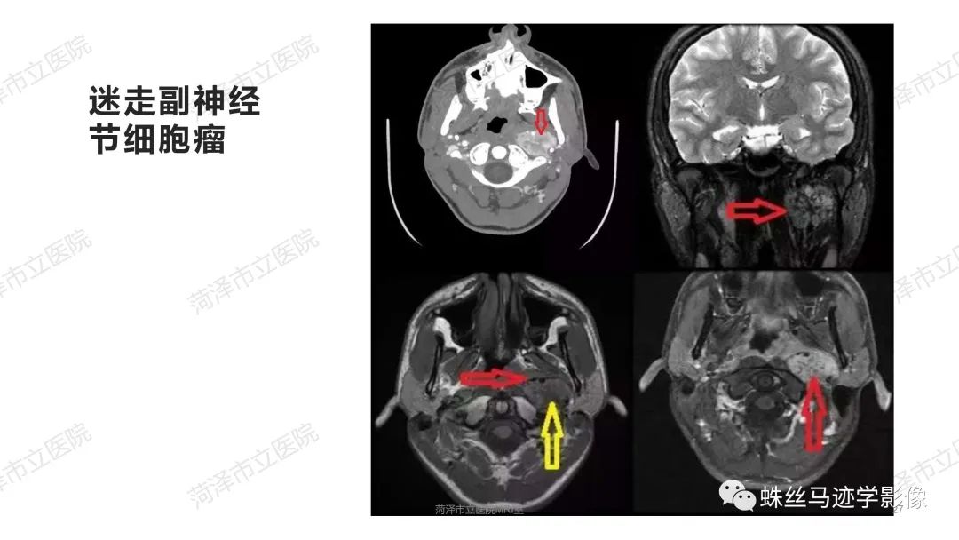 影像PPT - 【PPT】颈部间隙CT和MRI诊断-27
