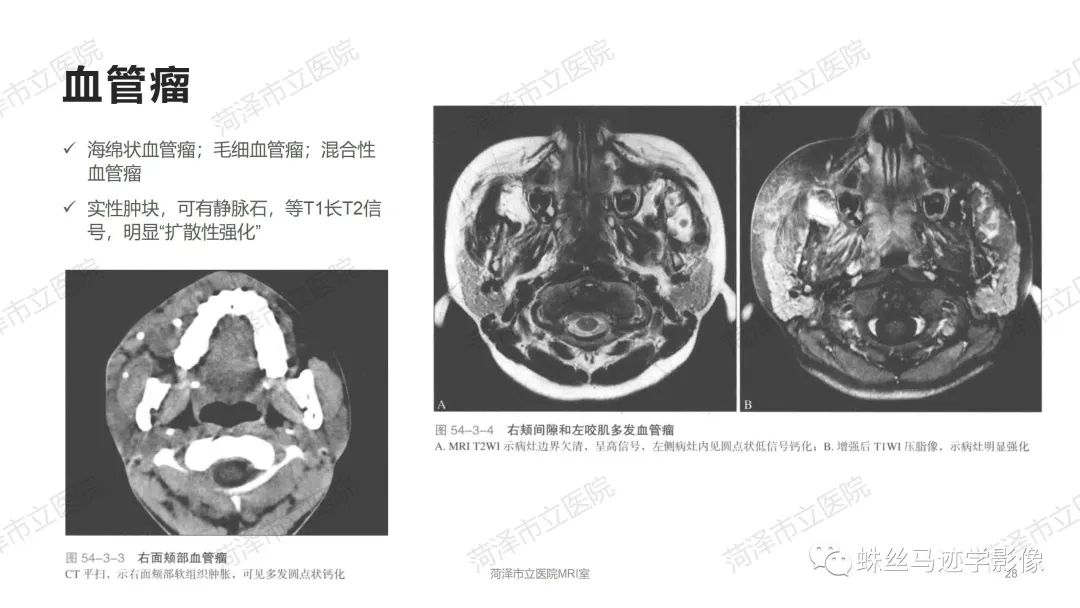 影像PPT - 【PPT】颈部间隙CT和MRI诊断-28