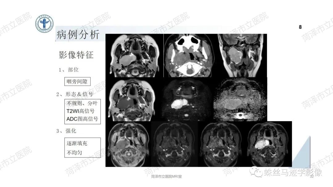 影像PPT - 【PPT】颈部间隙CT和MRI诊断-32