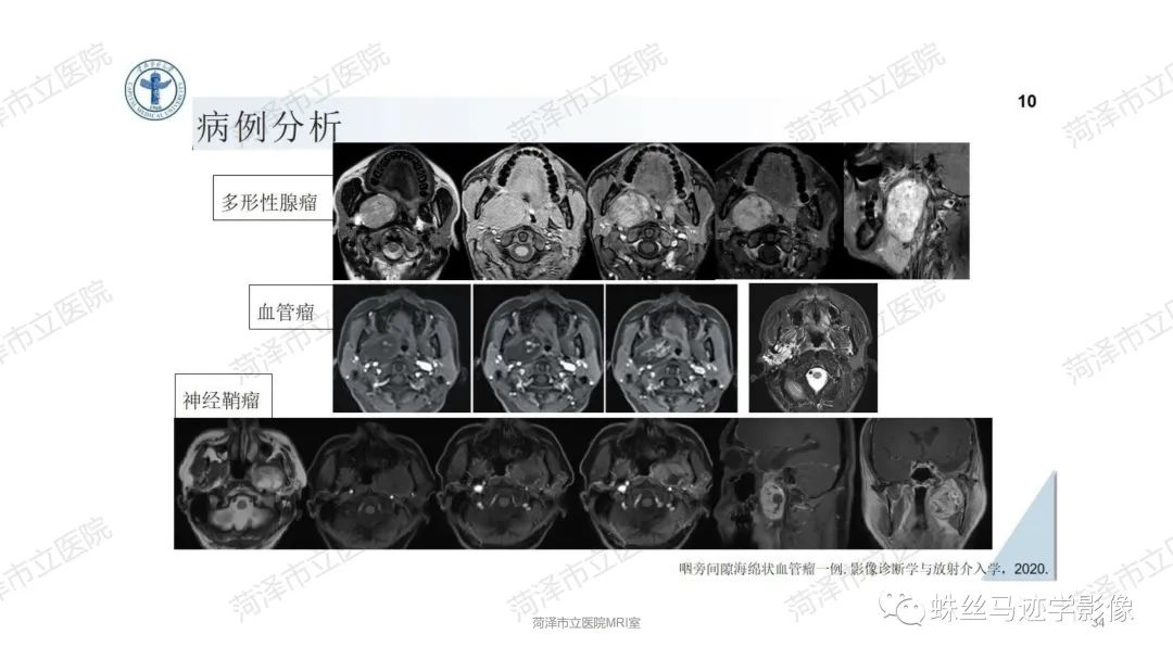 影像PPT - 【PPT】颈部间隙CT和MRI诊断-34