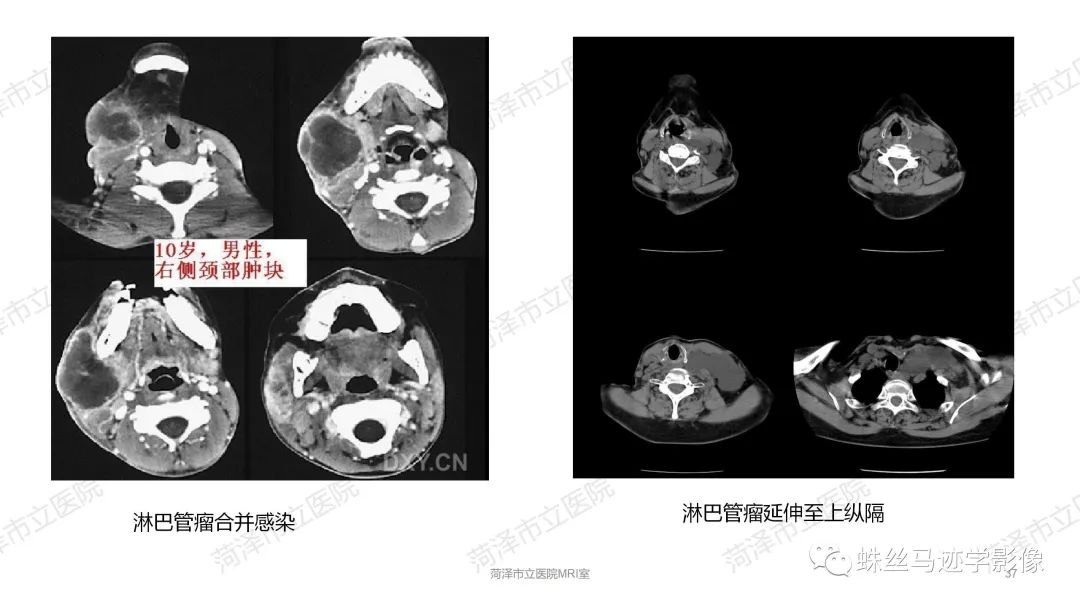 影像PPT - 【PPT】颈部间隙CT和MRI诊断-37