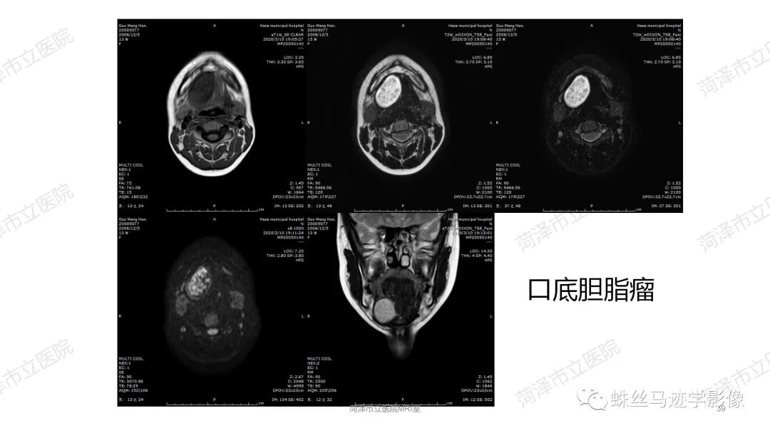 影像PPT - 【PPT】颈部间隙CT和MRI诊断-39