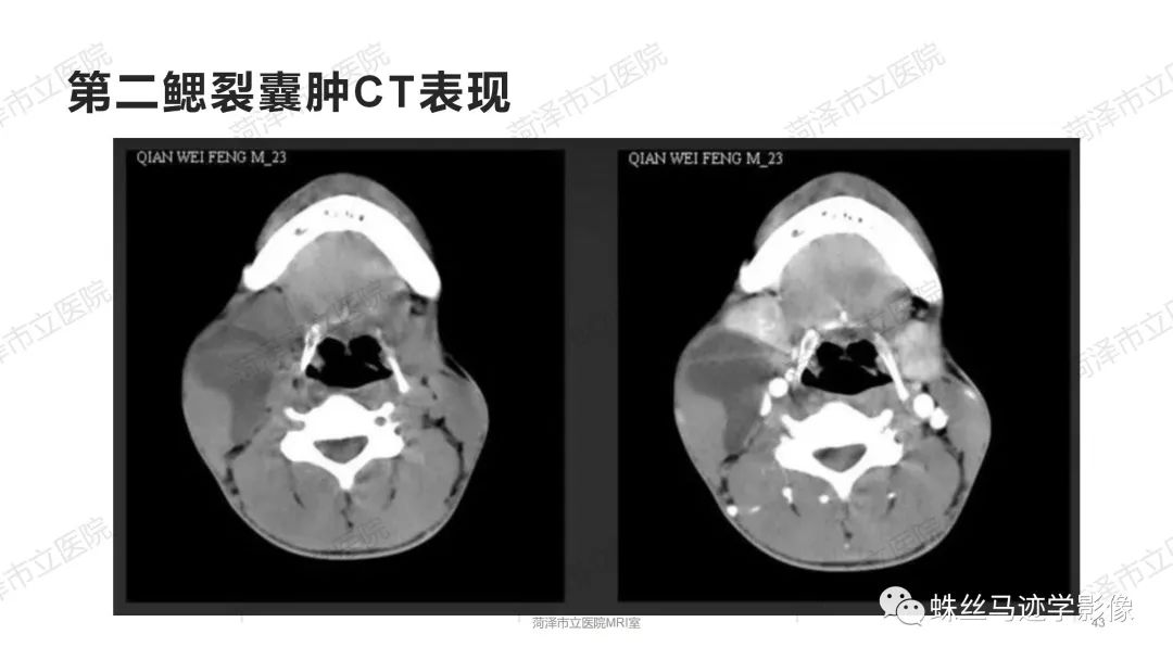 影像PPT - 【PPT】颈部间隙CT和MRI诊断-43