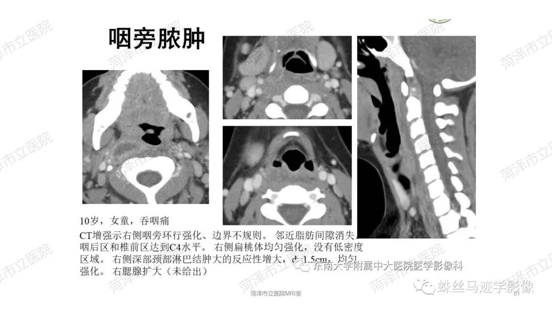 影像PPT - 【PPT】颈部间隙CT和MRI诊断-51