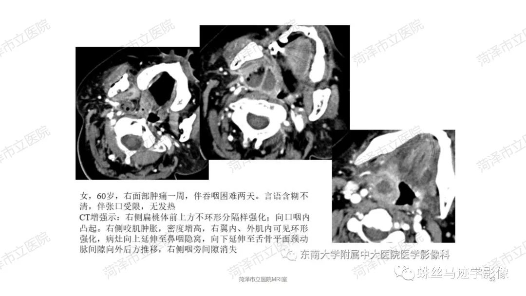 影像PPT - 【PPT】颈部间隙CT和MRI诊断-52
