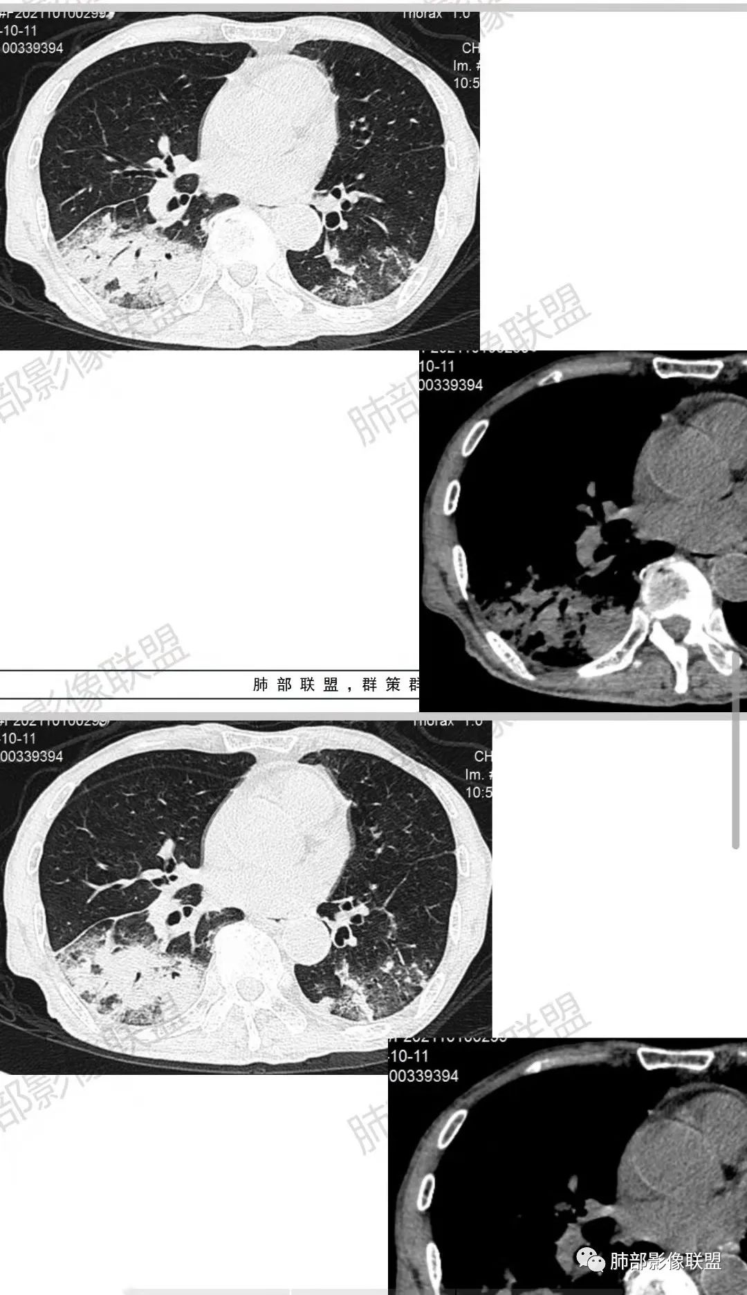 影像PPT - 【病例】诡异的肺部感染—诺卡菌-18 影像PPT - 【病例】诡异的肺部感染—诺卡菌-18