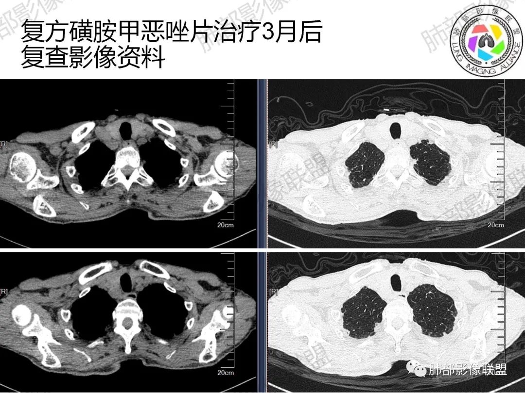 影像PPT - 【病例】诡异的肺部感染—诺卡菌-23 影像PPT - 【病例】诡异的肺部感染—诺卡菌-23