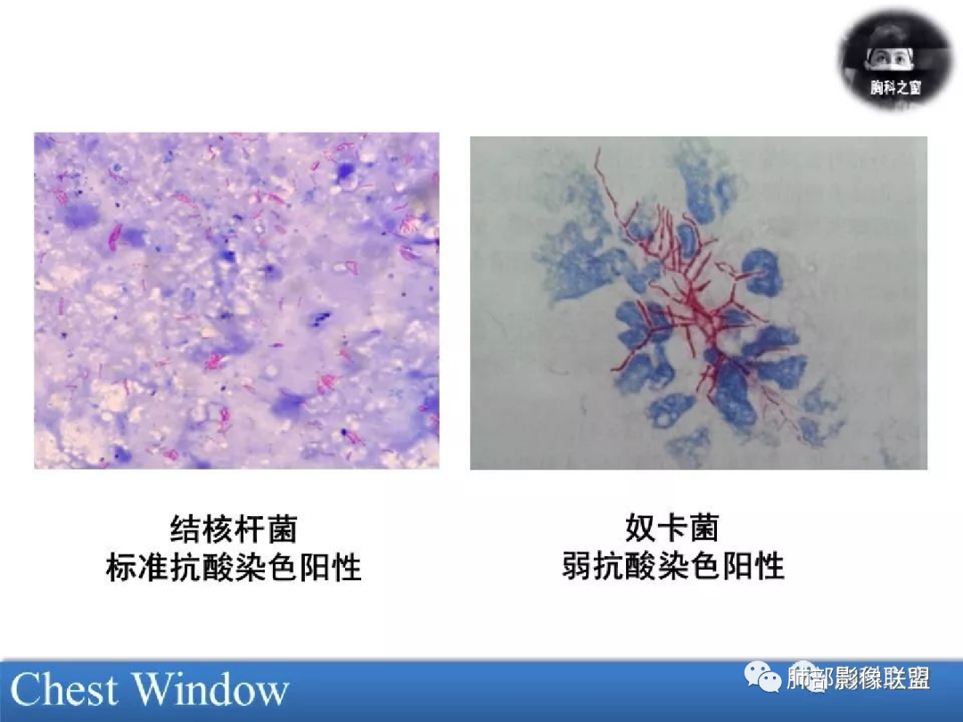 影像PPT - 【病例】诡异的肺部感染—诺卡菌-31 影像PPT - 【病例】诡异的肺部感染—诺卡菌-31