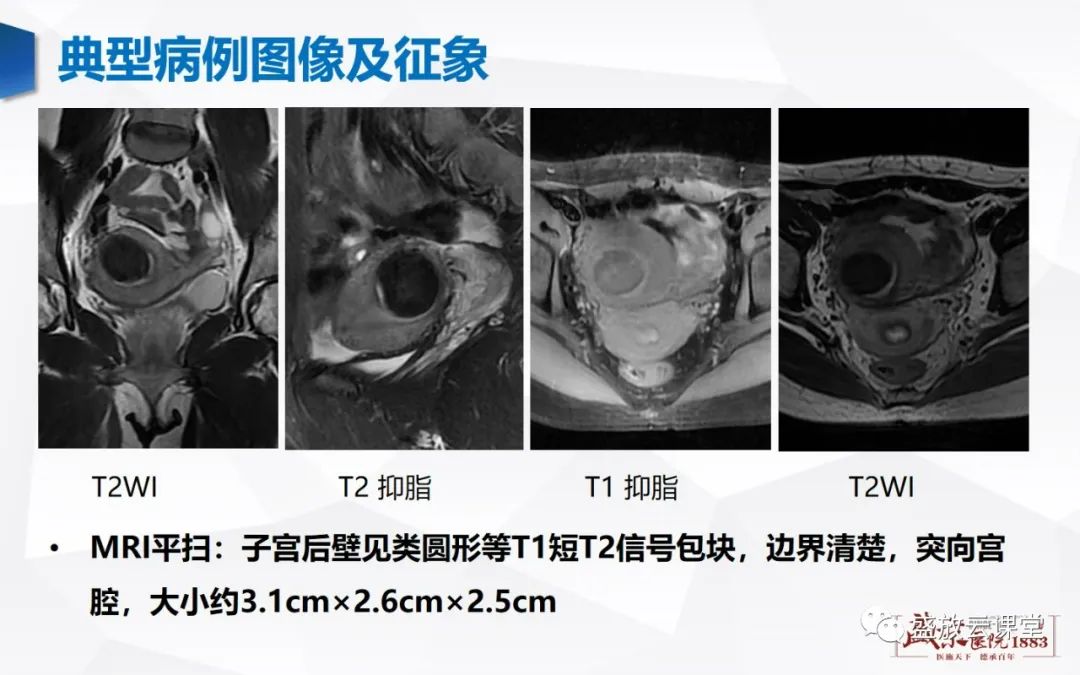 影像PPT - 【病例】特殊类型子宫平滑肌瘤3例MR影像鉴别-4