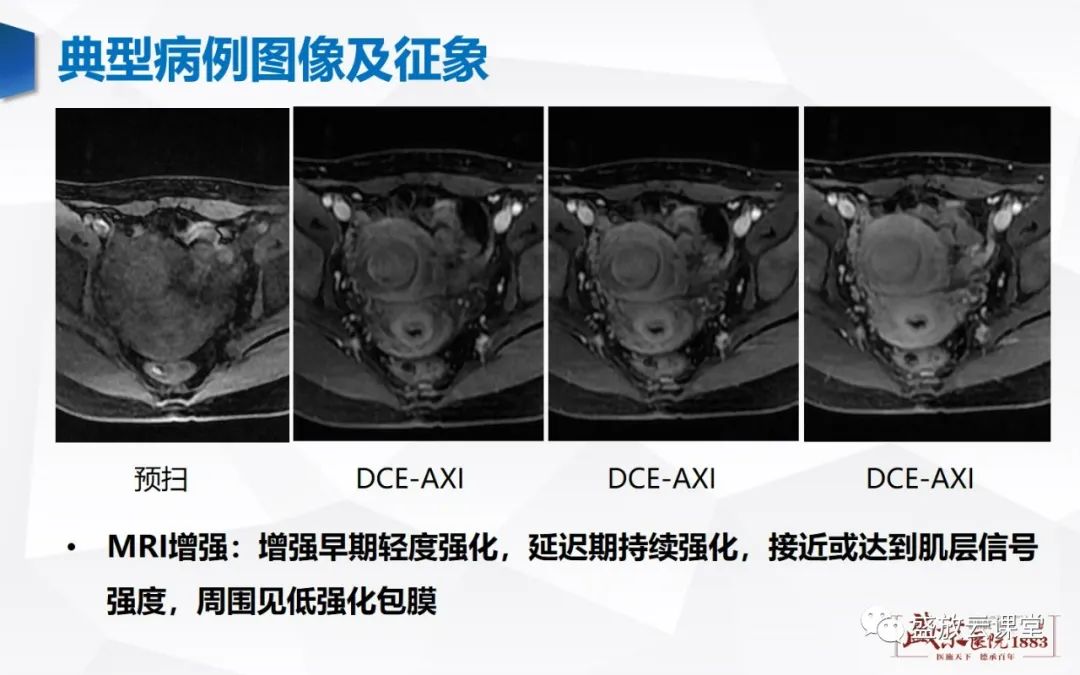 影像PPT - 【病例】特殊类型子宫平滑肌瘤3例MR影像鉴别-5