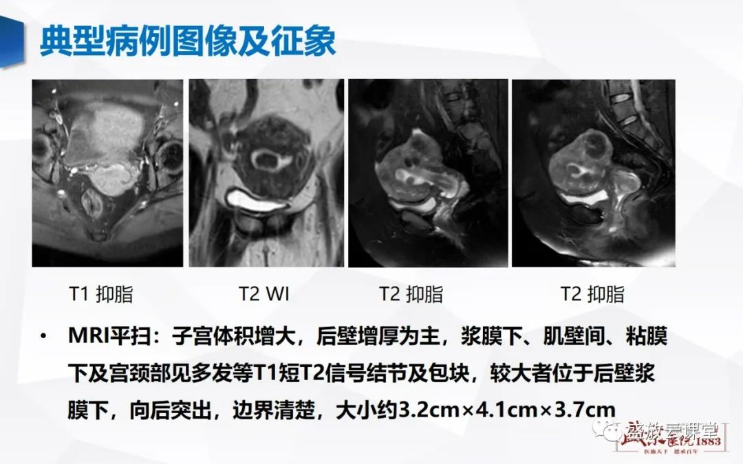 影像PPT - 【病例】特殊类型子宫平滑肌瘤3例MR影像鉴别-9