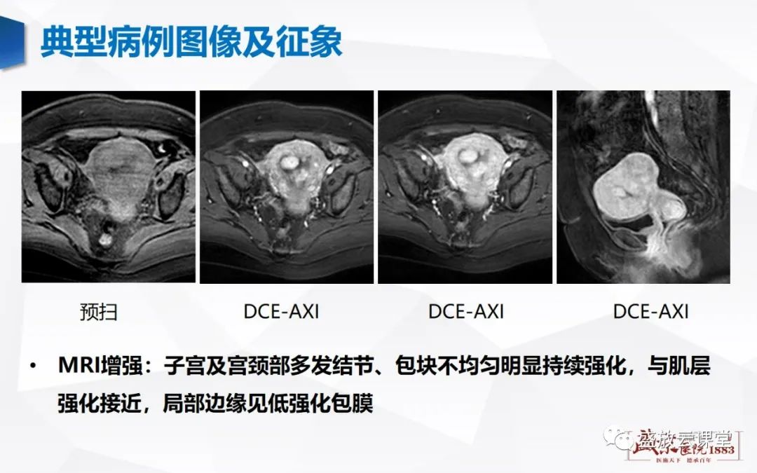 影像PPT - 【病例】特殊类型子宫平滑肌瘤3例MR影像鉴别-10
