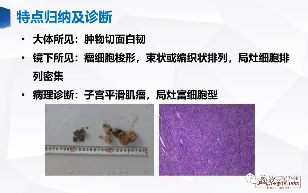 影像PPT - 【病例】特殊类型子宫平滑肌瘤3例MR影像鉴别-13
