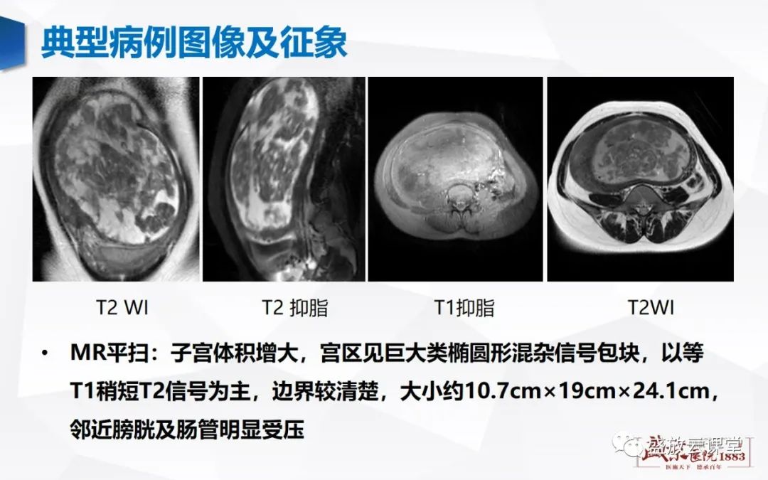 影像PPT - 【病例】特殊类型子宫平滑肌瘤3例MR影像鉴别-20