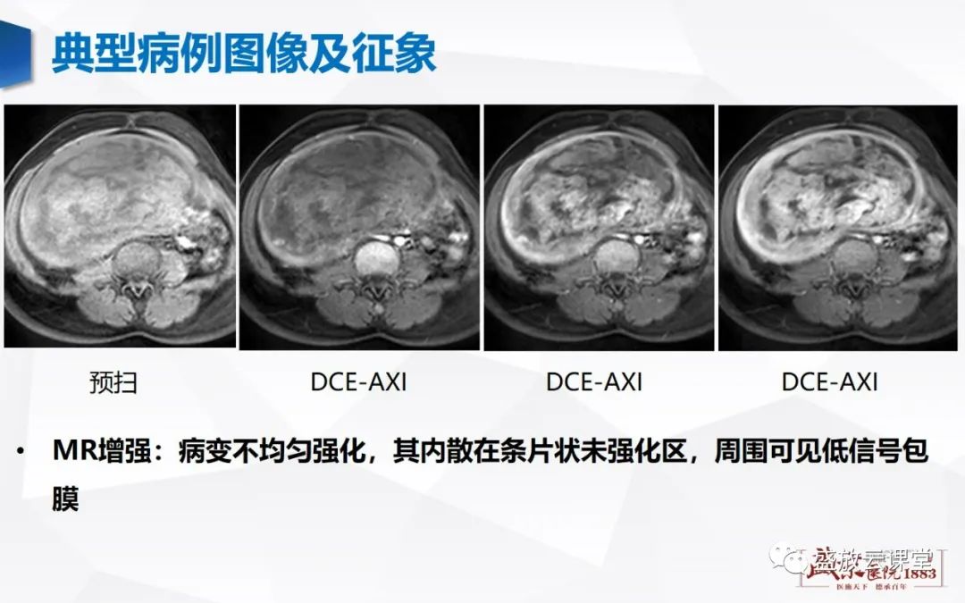 影像PPT - 【病例】特殊类型子宫平滑肌瘤3例MR影像鉴别-21