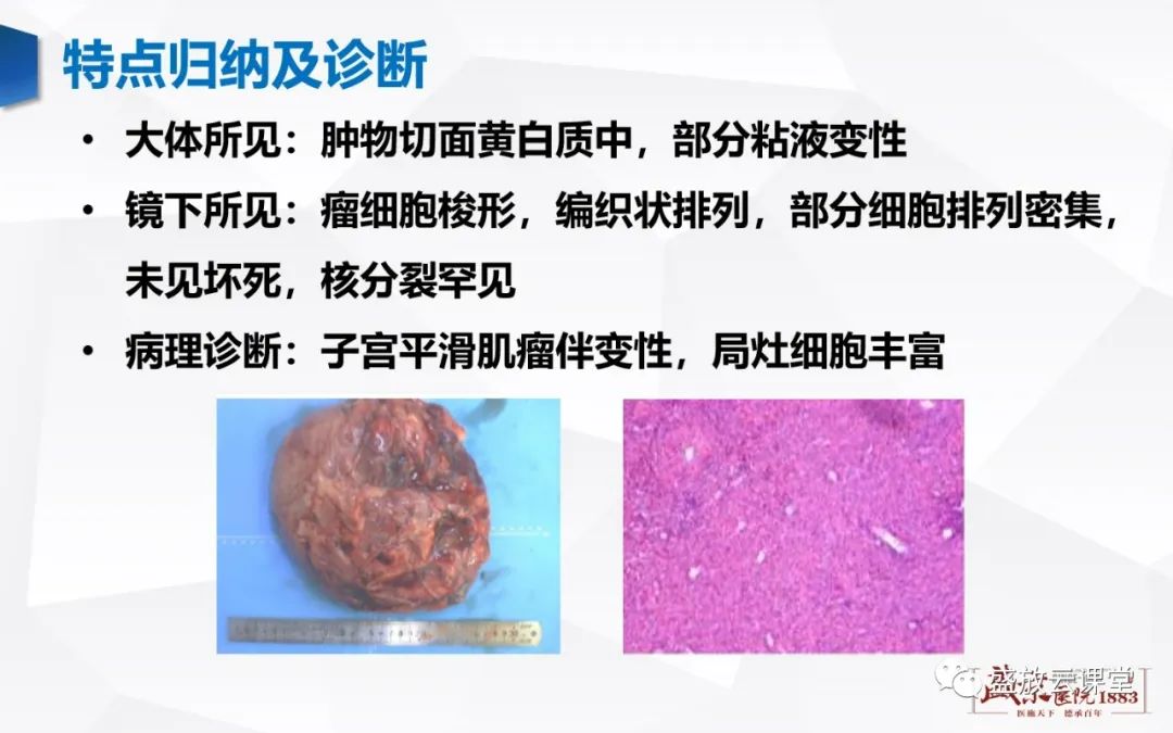 影像PPT - 【病例】特殊类型子宫平滑肌瘤3例MR影像鉴别-24