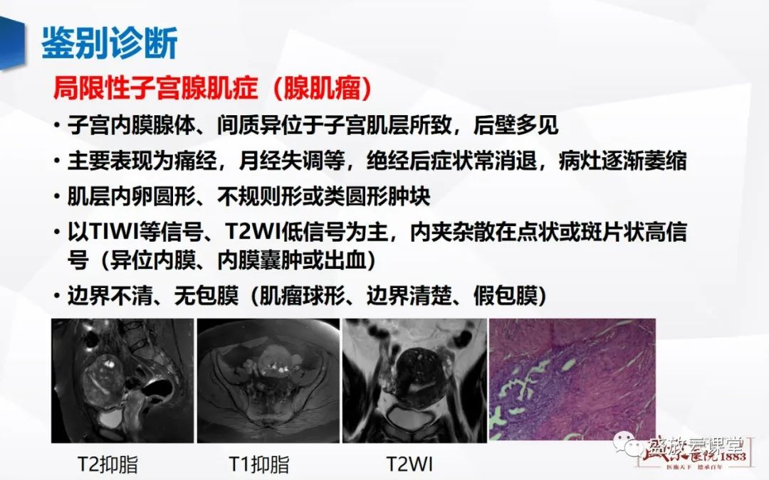 影像PPT - 【病例】特殊类型子宫平滑肌瘤3例MR影像鉴别-25