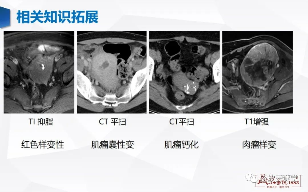 影像PPT - 【病例】特殊类型子宫平滑肌瘤3例MR影像鉴别-29