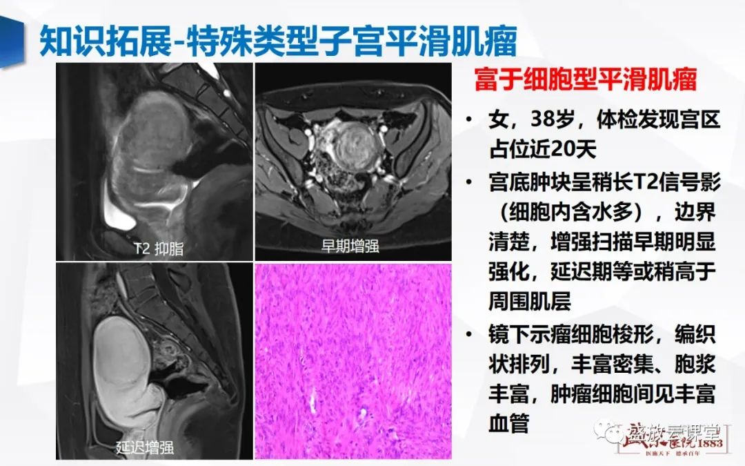 影像PPT - 【病例】特殊类型子宫平滑肌瘤3例MR影像鉴别-32