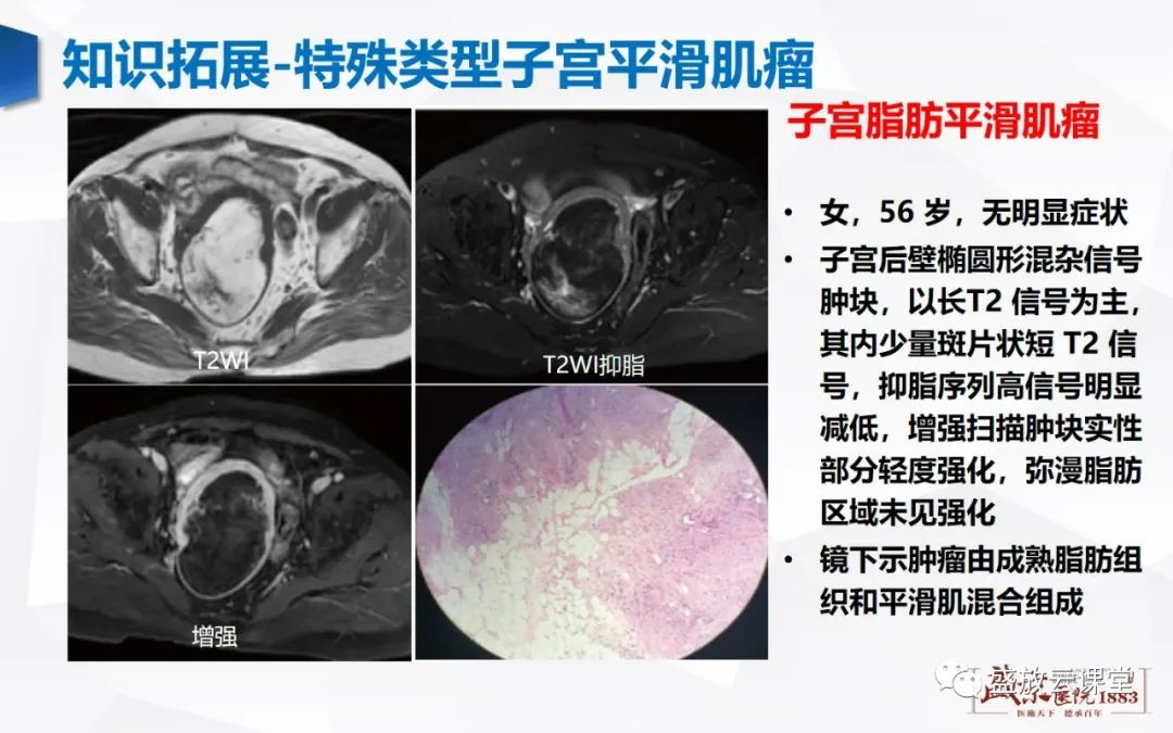 影像PPT - 【病例】特殊类型子宫平滑肌瘤3例MR影像鉴别-34