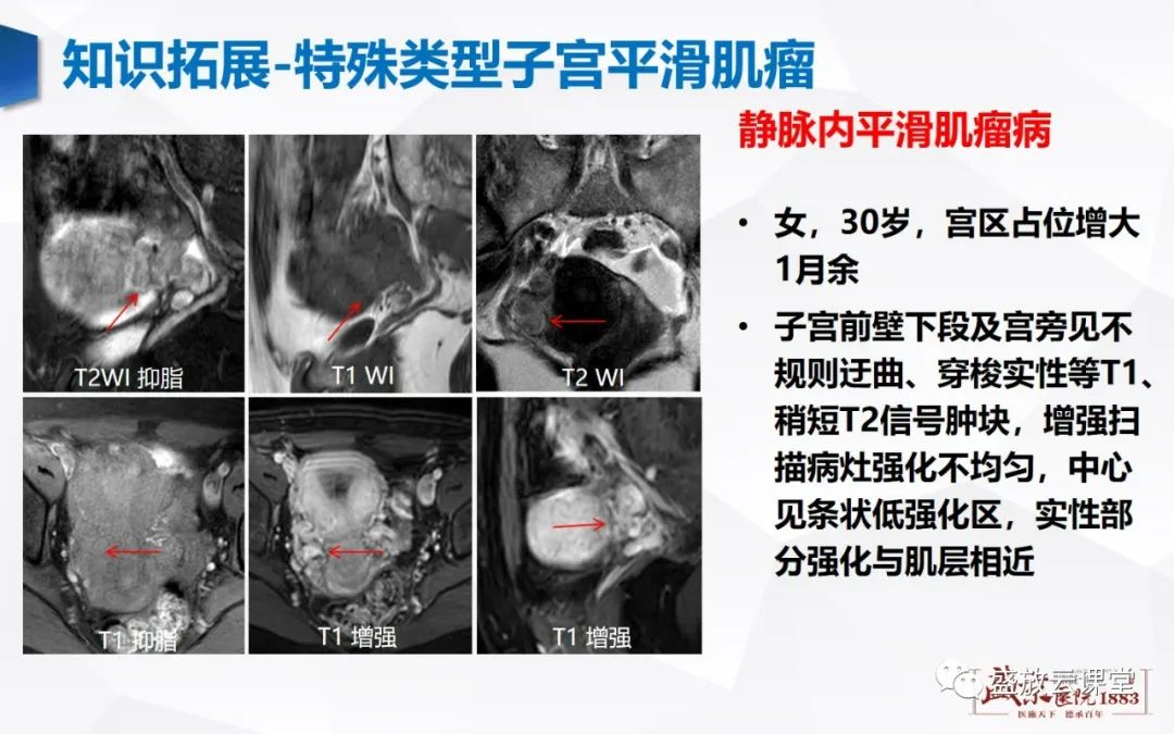 影像PPT - 【病例】特殊类型子宫平滑肌瘤3例MR影像鉴别-37