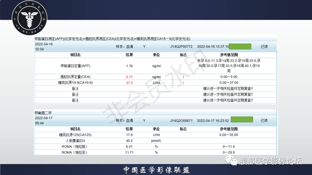影像PPT - 【病例】盆腔腹膜后去分化脂肪肉瘤1例MR-4