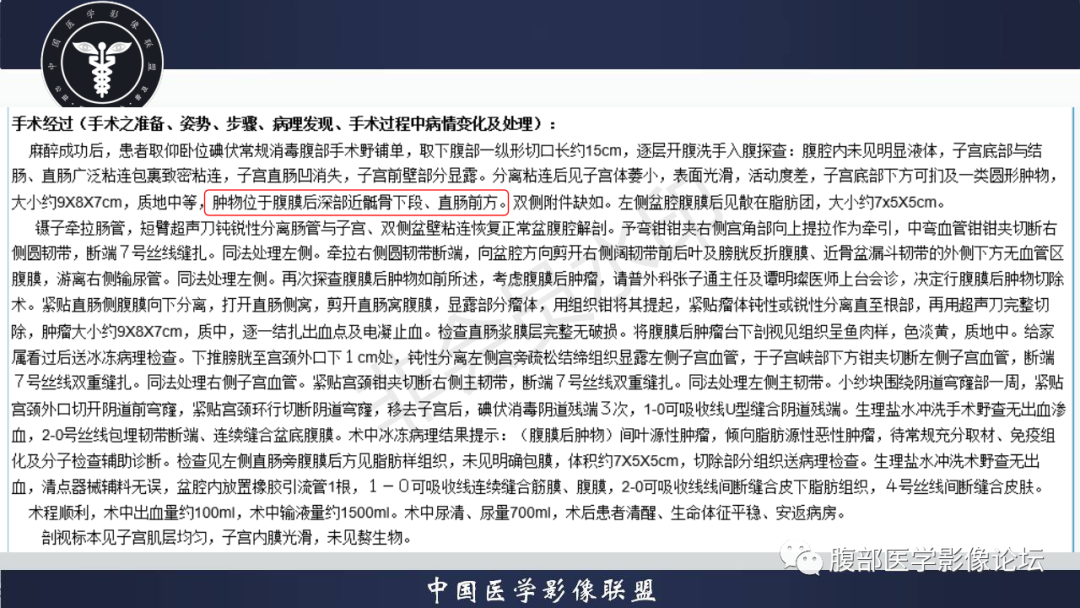 影像PPT - 【病例】盆腔腹膜后去分化脂肪肉瘤1例MR-42