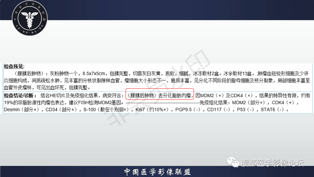 影像PPT - 【病例】盆腔腹膜后去分化脂肪肉瘤1例MR-43