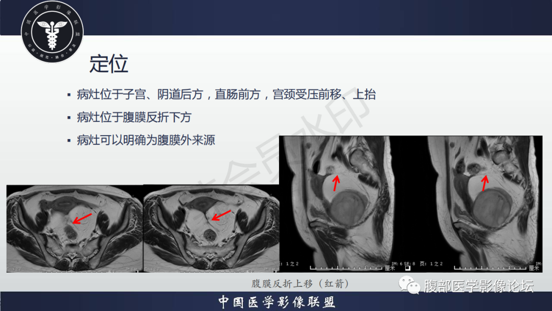 影像PPT - 【病例】盆腔腹膜后去分化脂肪肉瘤1例MR-44