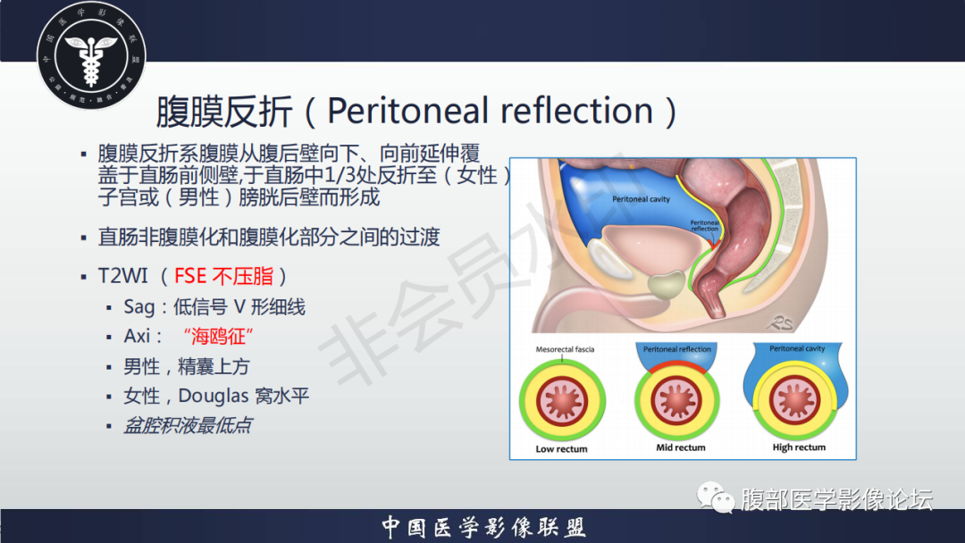 影像PPT - 【病例】盆腔腹膜后去分化脂肪肉瘤1例MR-45
