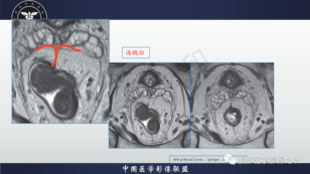 影像PPT - 【病例】盆腔腹膜后去分化脂肪肉瘤1例MR-46