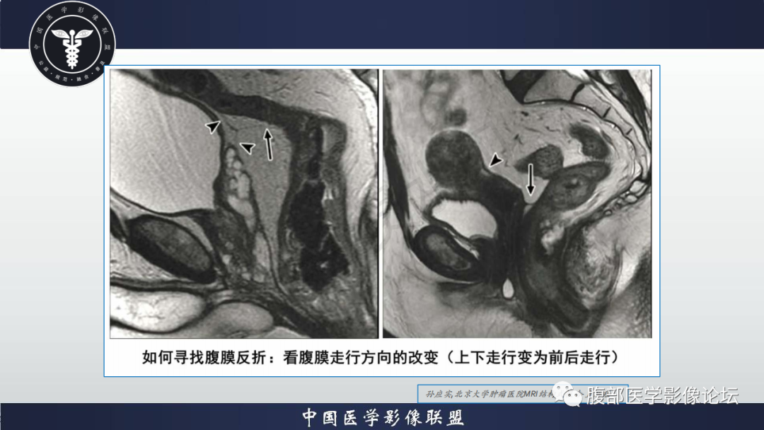 影像PPT - 【病例】盆腔腹膜后去分化脂肪肉瘤1例MR-47