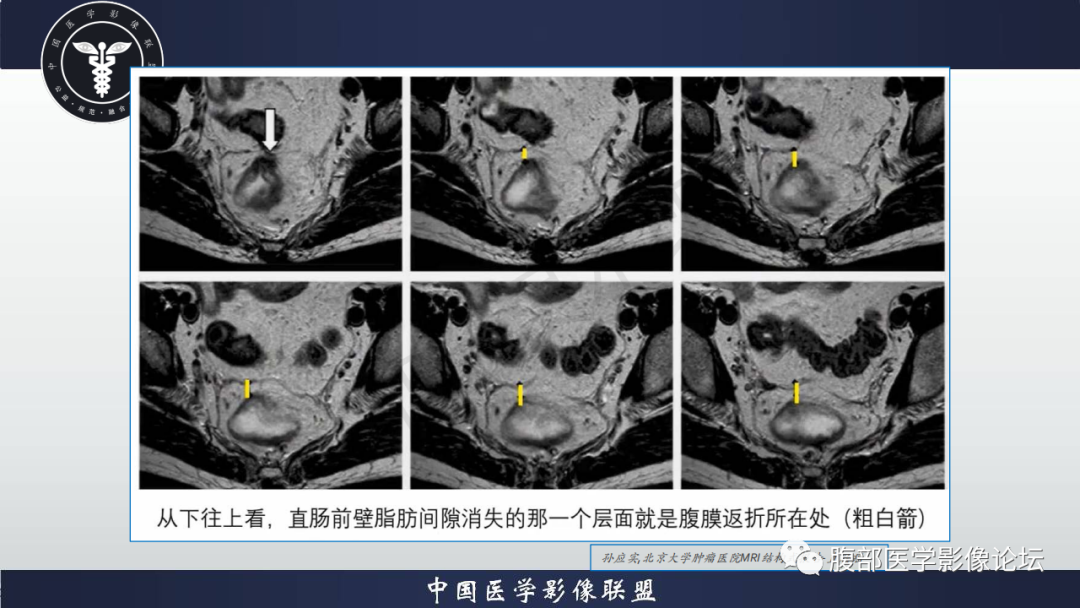 影像PPT - 【病例】盆腔腹膜后去分化脂肪肉瘤1例MR-48