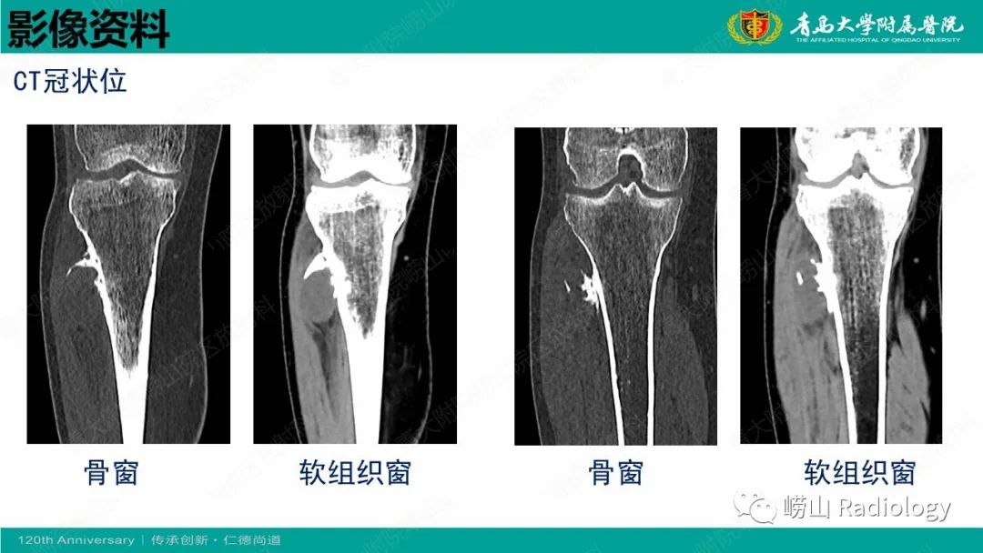 影像PPT - 【病例】胫骨骨膜软骨肉瘤1例CT及MR-5
