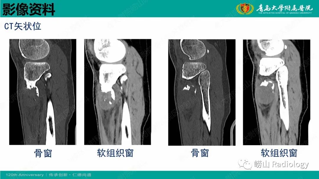 影像PPT - 【病例】胫骨骨膜软骨肉瘤1例CT及MR-6