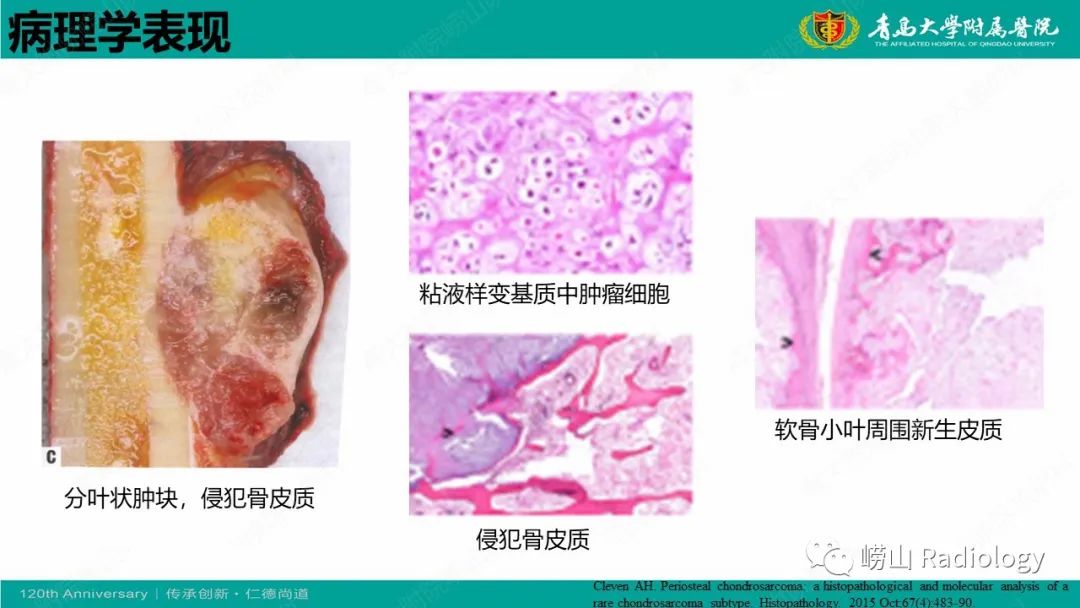 影像PPT - 【病例】胫骨骨膜软骨肉瘤1例CT及MR-14