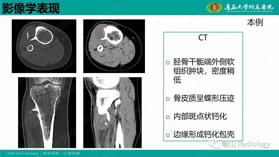 影像PPT - 【病例】胫骨骨膜软骨肉瘤1例CT及MR-17